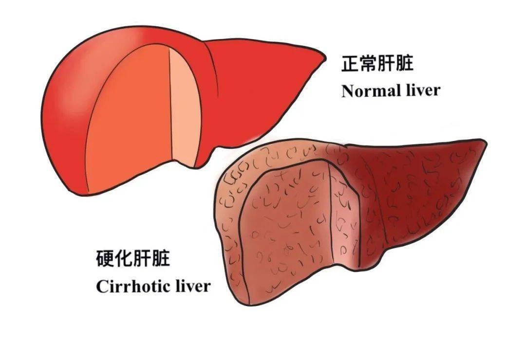 对肝硬化认识和治疗的误区有这些，看你有没有迷茫过！(图1)